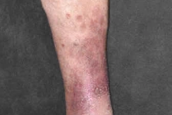 Vasculaire Insufficiëntie